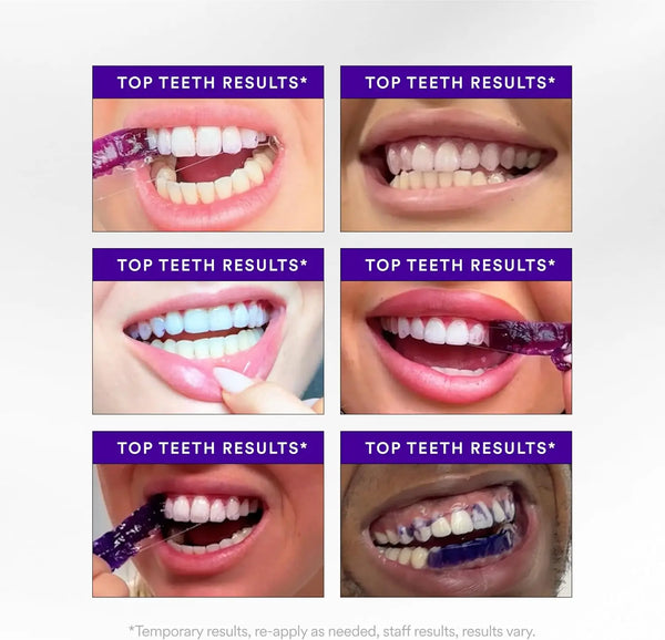 Radiant Smile Whitening Strips
