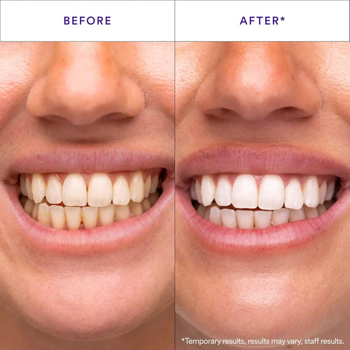 Radiant Smile Whitening Strips
